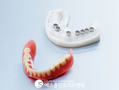 전체임플란트, 당일 임플란트 시술과정 관련 이미지 1