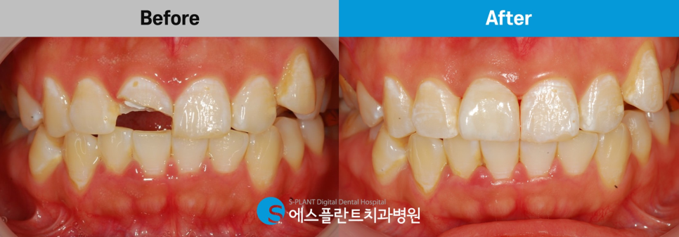 강남 부러진 앞니 임플란트 잘하는 치과, 에스플란트치과병원(전치부 발치 즉시 임플란트 및 당일 임시치아 세팅) 관련 이미지 7
