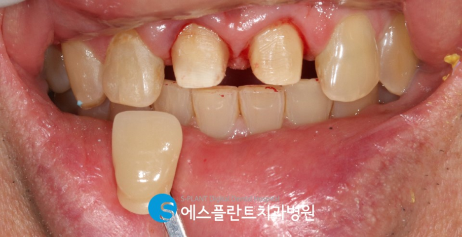 자연스러운 앞니 보철을 원한다면?! 압구정 앞니보철 잘하는 치과, 에스플란트치과병원에서 관련 이미지 4