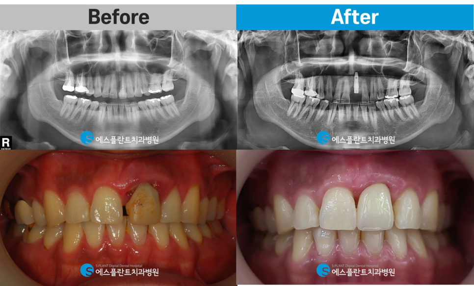 압구정로데오역 임플란트 잘하는 에스플란트치과병원, 당일 임플란트 발치 후 즉시 식립 임플란트 관련 이미지 7