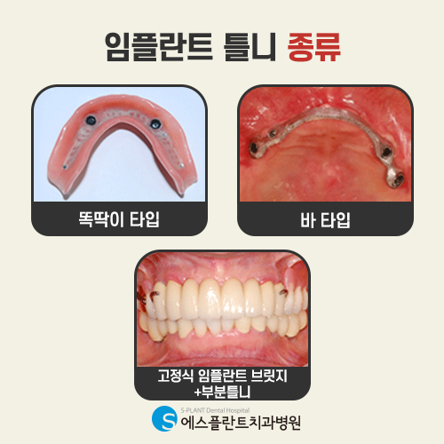 틀니와 임플란트를 결합한 치료가 있다면? [에스플란트 치과병원] 관련 이미지 5
