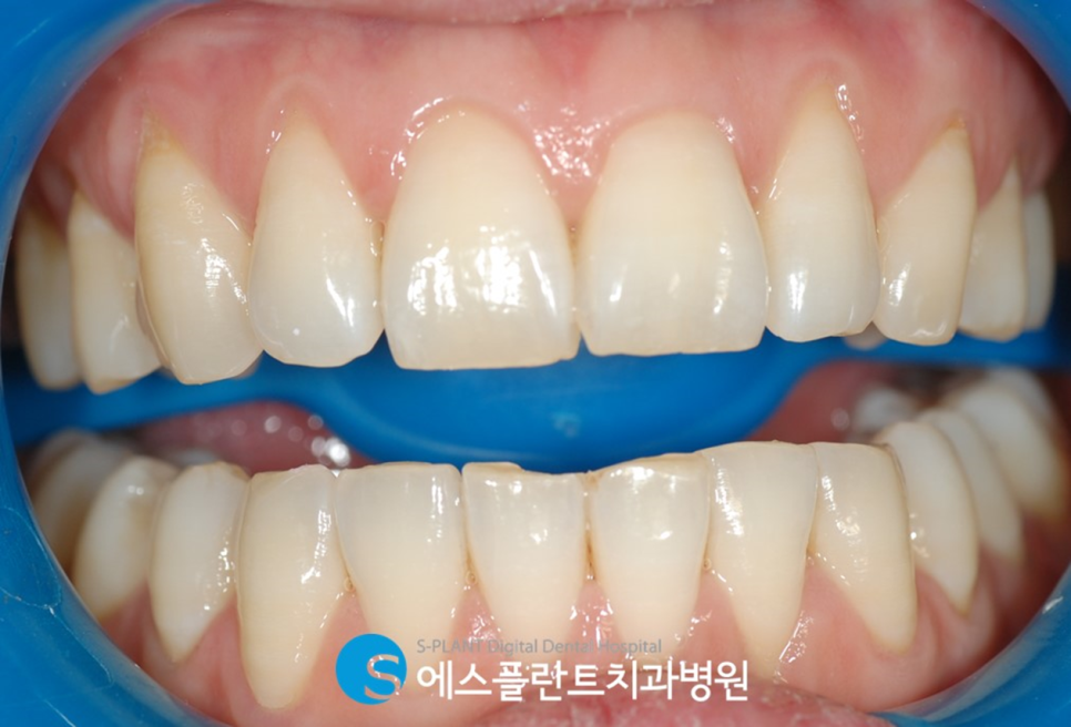 압구정로데오 치아미백 잘하는 치과, 에스플란트치과병원에서 착색된 치아를 하얗게 관련 이미지 3