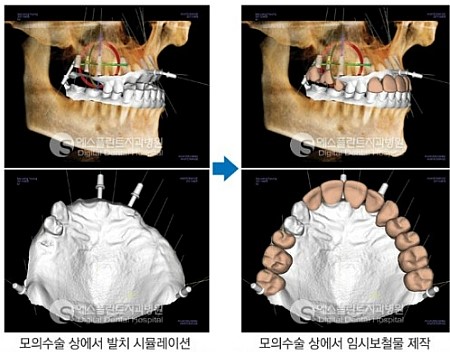[의료 영상 기기] 치과 의료 영상 기기, CT 임플란트 관련 이미지 7