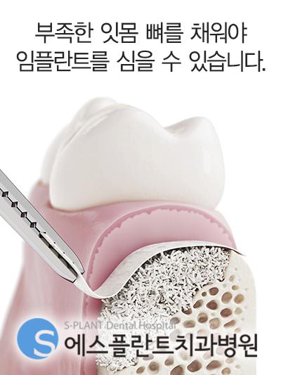 임플란트뼈이식통증,언제제일심한가요? 관련 이미지 1