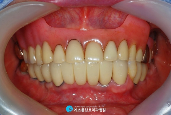 틀니가 헐겁고 불편하다면? 전악임플란트하세요.<에스플란트치과병원> 관련 이미지 2