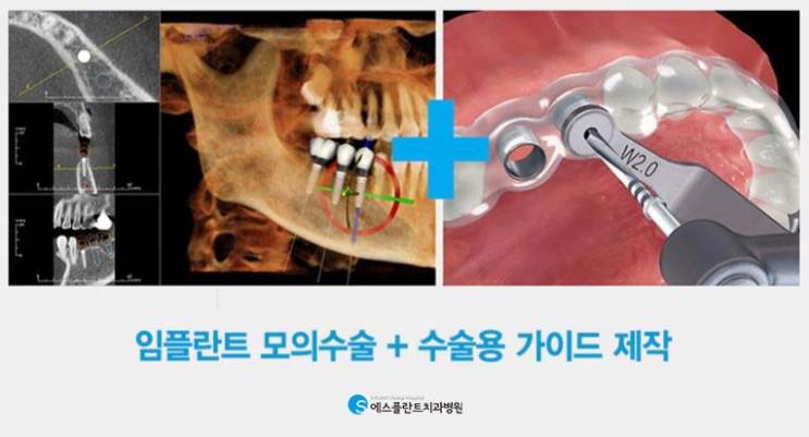 튼튼함이중요한어금니임플란트 관련 이미지 6