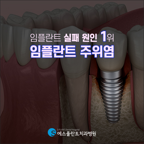 임플란트 실패 원인 1위, 임플란트 주위염이란? [에스플란트 치과병원] 관련 이미지 3