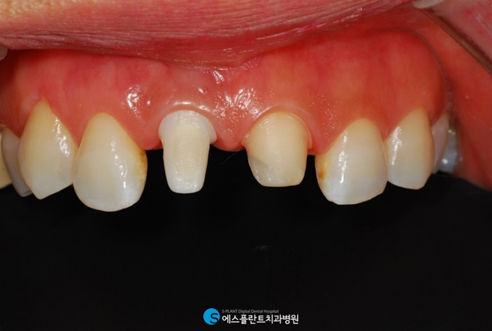 치아가 1/2 이상 부러졌다면? 크라운 치료 진행하세요. 관련 이미지 4