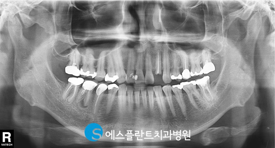 아름다운 미소를 위한 앞니 임플란트는 압구정로데오 에스플란트 치과병원에서 관련 이미지 2