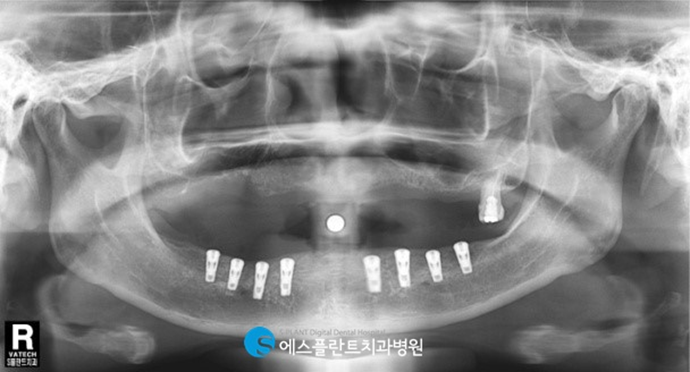 전악임플란트로 치아 기능을 회복하세요! <전악임플란트 치료사례> 관련 이미지 3