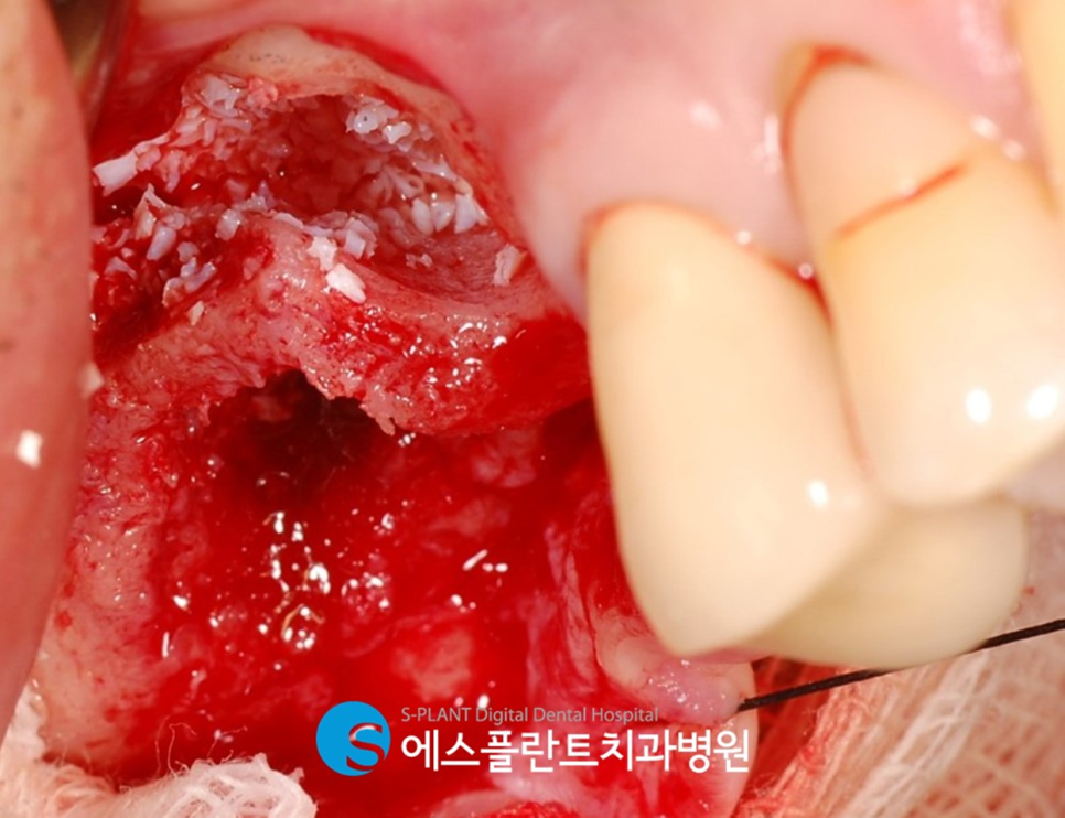 고난이도 상악동 거상술 임플란트 잘하는 치과, 에스플란트 치과병원 관련 이미지 6