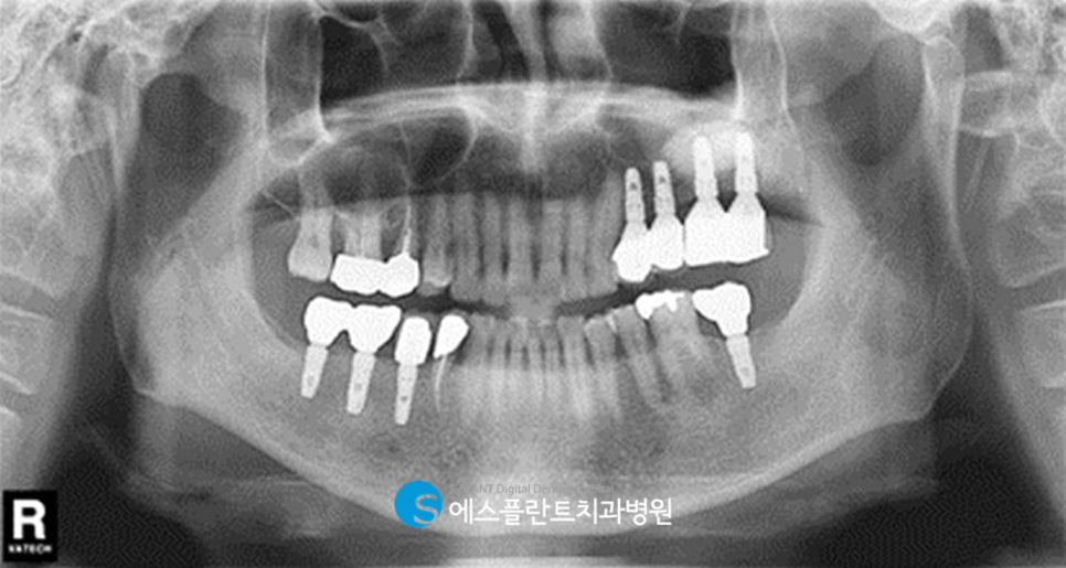 에스플란트치과병원의 고난이도 상악동 거상술을 동반한 임플란트 식립 후 10년 경과 케이스 관련 이미지 7