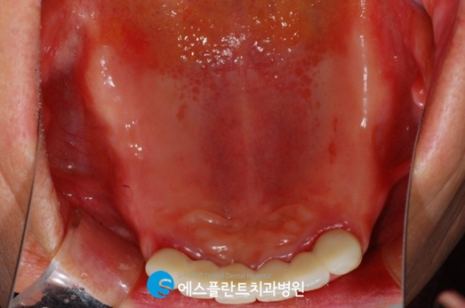 어금니임플란트로 건강한 식생활을 유지하세요! 관련 이미지 3