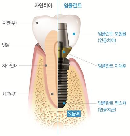[압구정로데오역 치과] 앞니 임플란트, 케이스별 맞춤 치료가 중요한 임 플란트! 관련 이미지 1