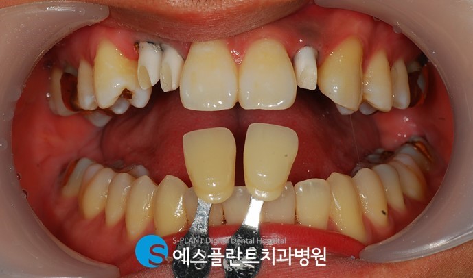 강남 임플란트 잇몸뼈 부족 시, 에스플란트 치과병원의 골이식 임플란트(GBR)로 관련 이미지 5