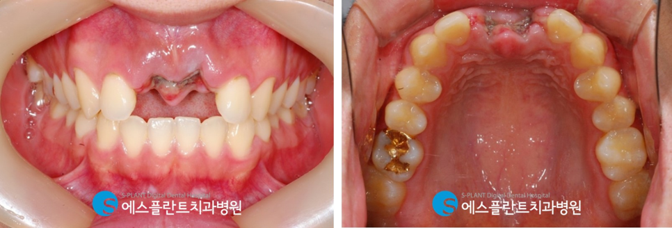 1:1 전담 상담 및 진료를 통한 에스플란트치과의 고난이도 관련 이미지 3