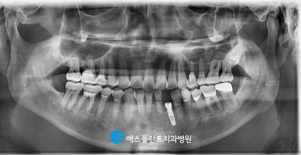 압구정로데오 임플란트 잘하는 치과, 만성치주염으로 인해 빠져버린 치아 뼈이식을 동반한 하악 앞니 임플란트 관련 이미지 6
