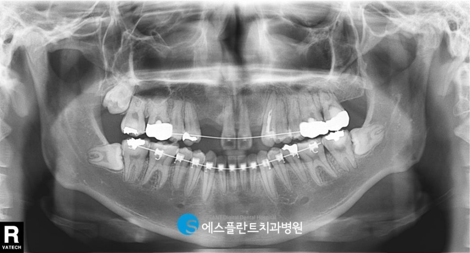 강남 임플란트 잇몸뼈 부족 시, 에스플란트 치과병원의 골이식 임플란트(GBR)로 관련 이미지 2