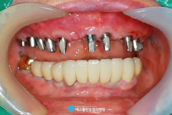 틀니가 헐겁고 불편하다면? 전악임플란트하세요.<에스플란트치과병원> 관련 이미지 5
