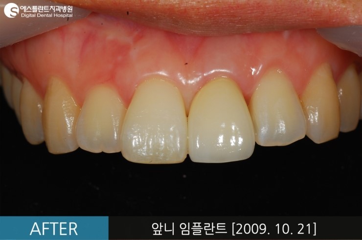 [뼈이식임플란트] 앞니 임플란트, 뼈이식 앞니 임플란트 전후 CASE 관련 이미지 5