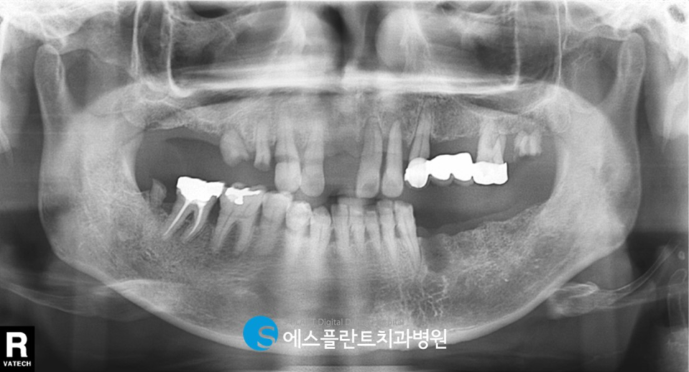 압구정 임플란트, 에스플란트치과병원의 편안하고 정확한 식립이 가능한 전악 가이드 임플란트 관련 이미지 3