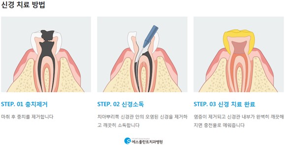 신경치료로 자연치아 살릴 수 있어요. 관련 이미지 3