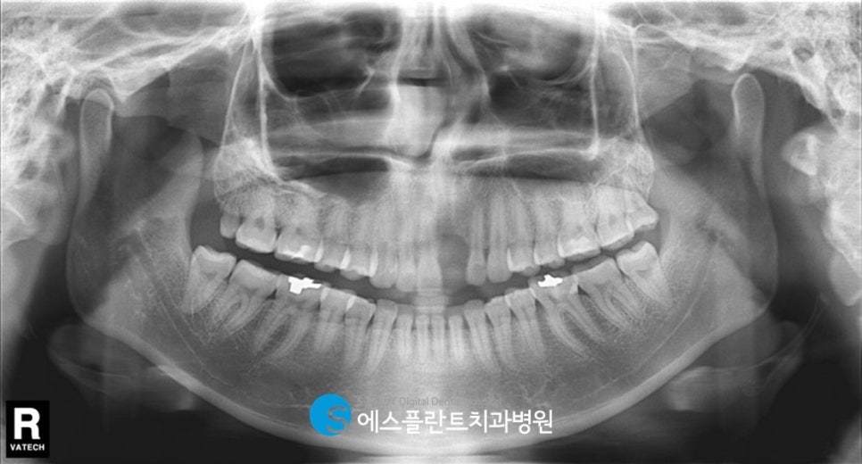 심미성과 기능성을 모두 고려한 압구정로데오 에스플란트치과병원의 앞니 임플란트 (가이드 임플란트) 관련 이미지 2