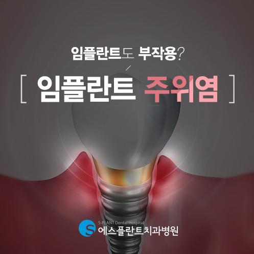 임플란트주위염 심각하면 재수술까지? 관련 이미지 1