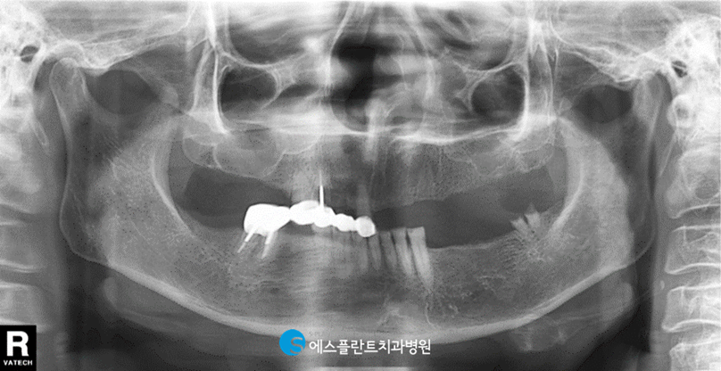 치아를 즉시 사용해야 한다면? 에스플란트치과에서 즉시기능임플란트 하세요! 관련 이미지 2