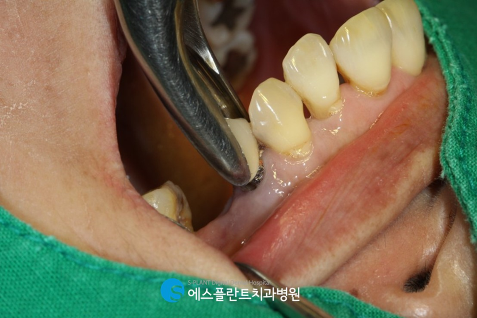 강남치과 에스플란트치과병원의 자가혈 임플란트(PRF)로 높은 성공률과 빠른 회복 관련 이미지 4