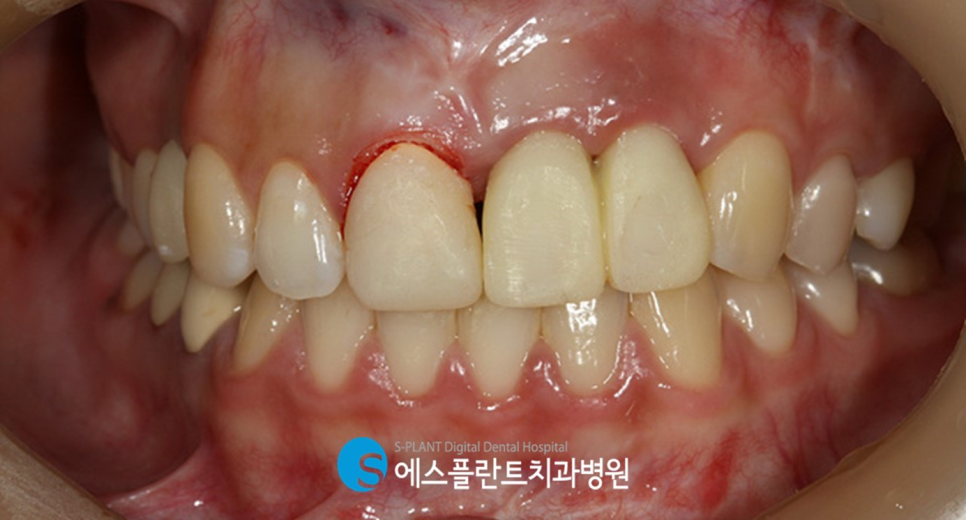 고난이도 앞니 심미 임플란트는 강남 에스플란트치과병원에서 관련 이미지 7