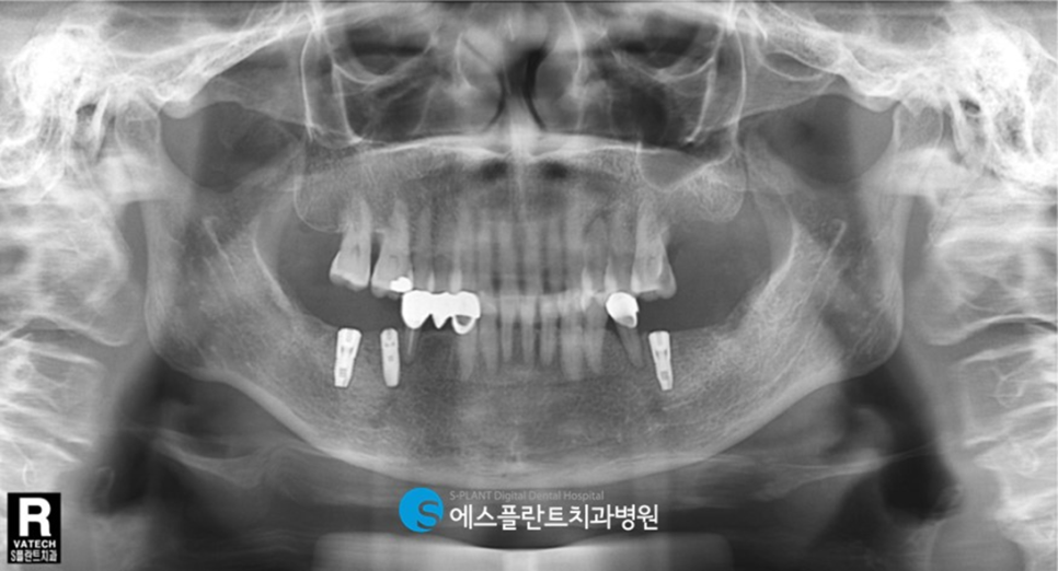하악 임플란트 잘하는 치과, 강남 에스플란트 치과병원에서 어금니 저작기능 회복 관련 이미지 4