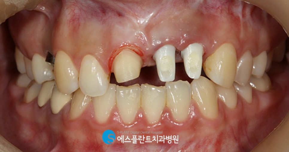 고난이도 앞니 심미 임플란트는 강남 에스플란트치과병원에서 관련 이미지 6