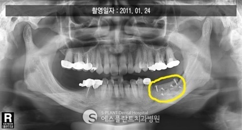 하악 어금니 임플란트뼈이식 관련 이미지 2