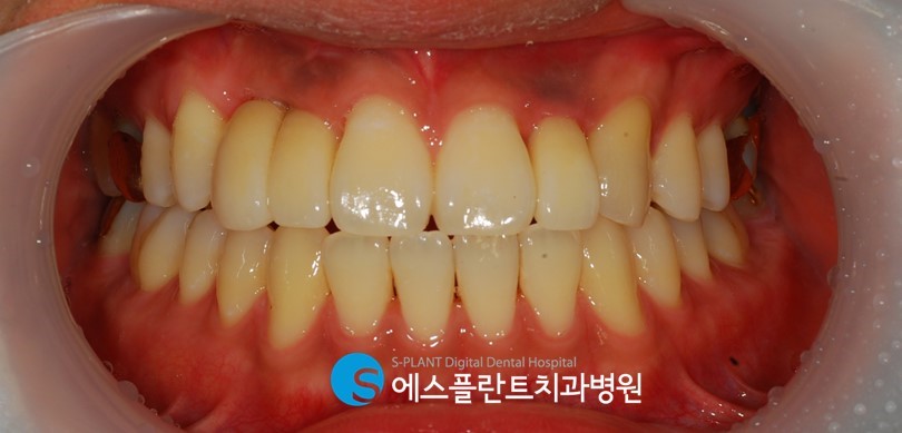 강남 임플란트 잇몸뼈 부족 시, 에스플란트 치과병원의 골이식 임플란트(GBR)로 관련 이미지 6