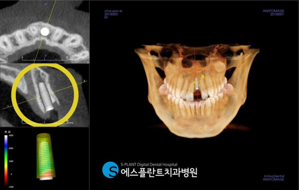 압구정 임플란트 잘하는 치과, 앞니 치관치근 파절 인한 임플란트 수술이 가능한 에스플란트치과병원 관련 이미지 2