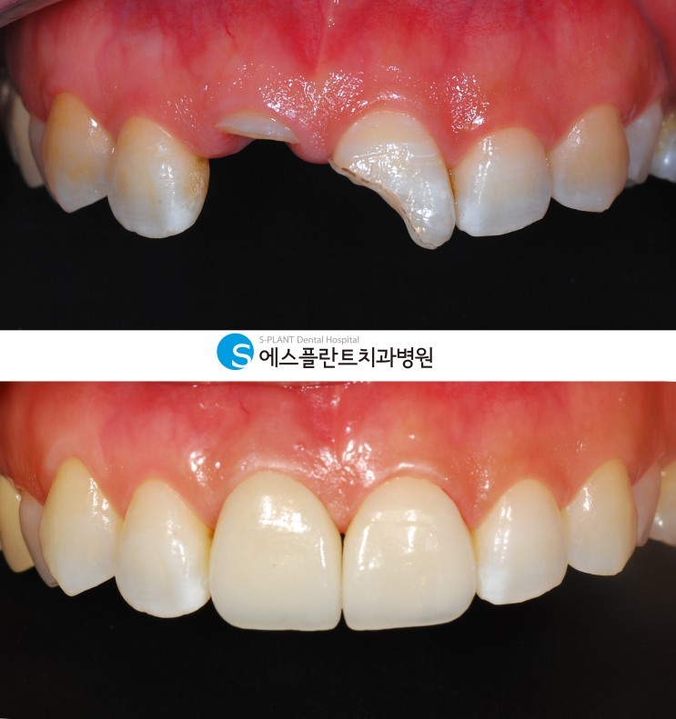 앞니 임플란트 내 치아처럼 자연스럽게 관련 이미지 5