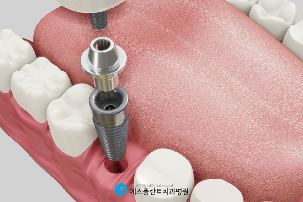 청담에서 임플란트 부작용 걱정 없이 수술받는 방법 관련 이미지 3