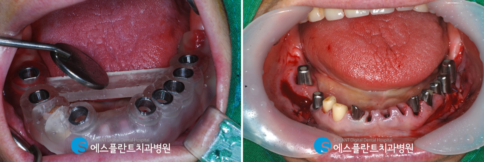 흔들리는 앞니 가이드 임플란트 브릿지 잘하는 치과 에스플란트치과병원 관련 이미지 5