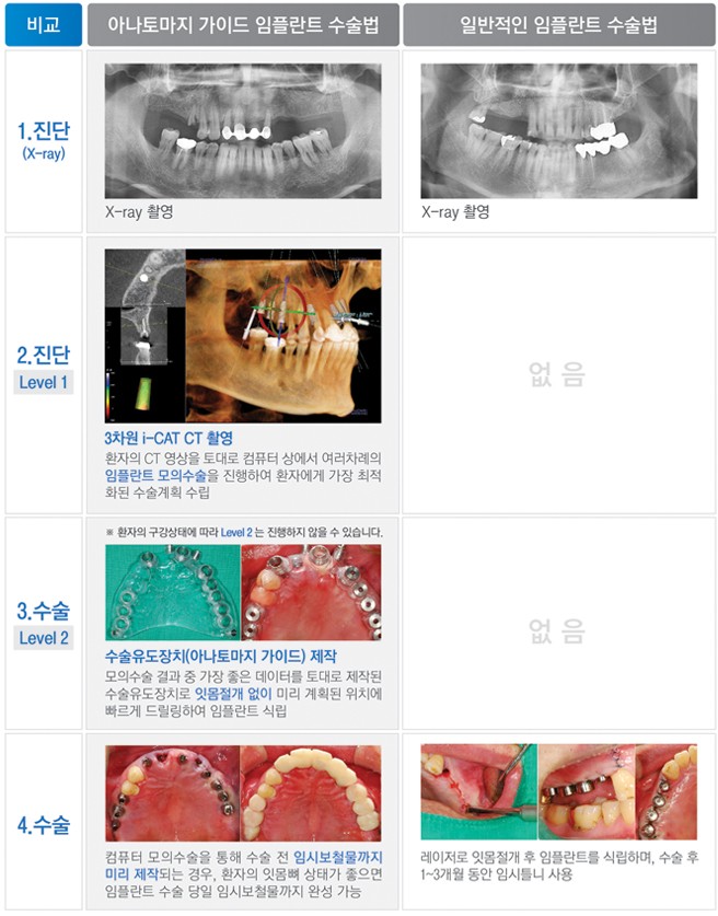 [메디컬코리아대상 에스플란트치과병원]강남임플란트, 임플란트시술 과정 관련 이미지 12