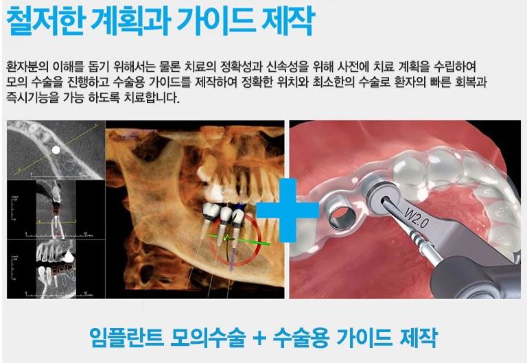 에스플란트 치과병원의 안전하고 빠른 전체 임플란트 관련 이미지 5