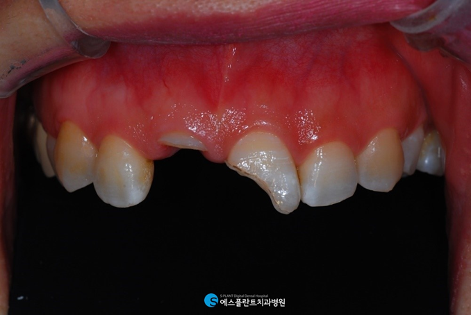 치아가 1/2 이상 부러졌다면? 크라운 치료 진행하세요. 관련 이미지 2
