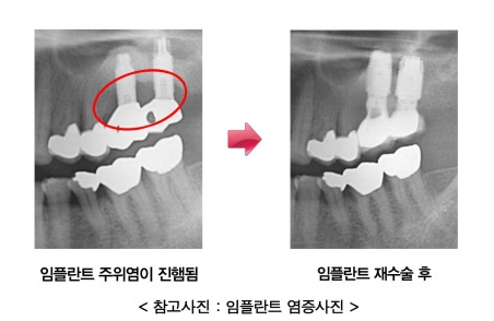 임플란트 주위염 예방법 없나요? 원인부터 해결방안까지 관련 이미지 3