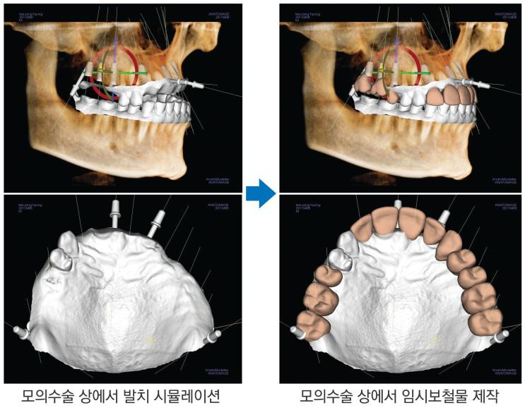 에스플란트치과병원이말하는 가이드임플란트는 &ldquo;진단과 계획이 중요해&rsquo; 관련 이미지 6