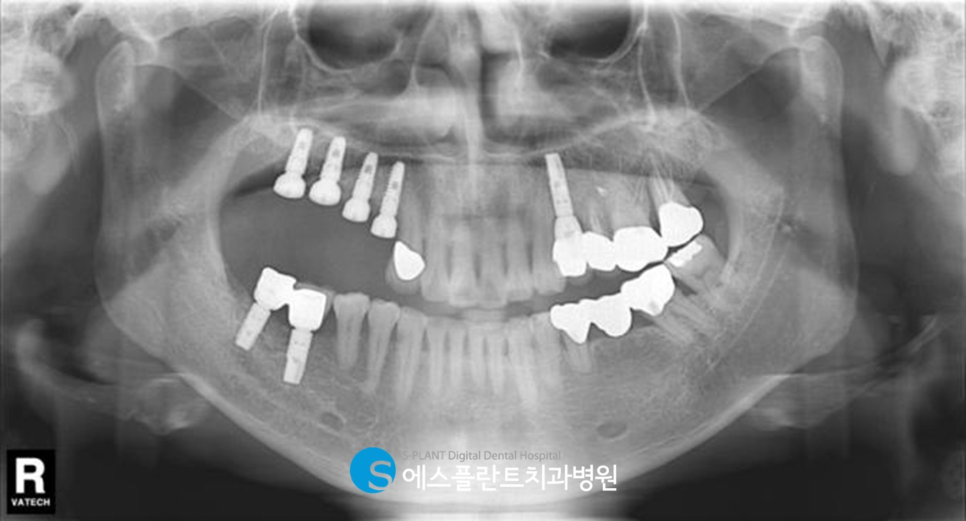저작기능의 핵심, 어금니 임플란트 식립에는 압구정 에스플란트 치과병원의 가이드 임플란트 관련 이미지 7