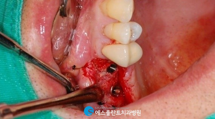 고난이도 임플란트 상악동거상술이 필요한 경우는? 관련 이미지 4