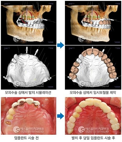 어금니 임플란트, 어금니 임플란트 시술과정 관련 이미지 10