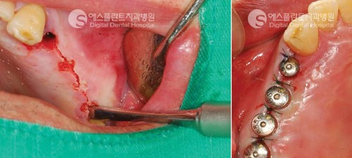 [청담동임플란트] 임플란트 통증, 임플란트 통증을 최소화한 아나토마 지 가이드 임플란트! 관련 이미지 2