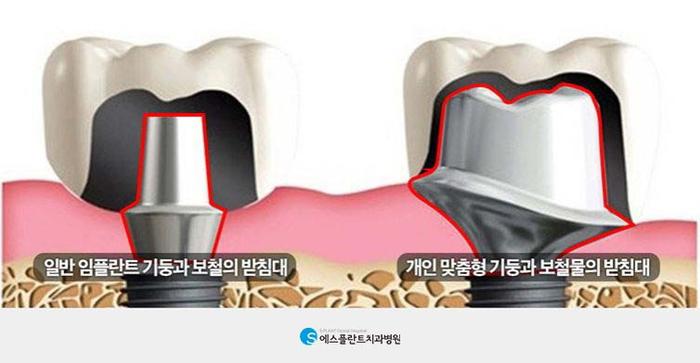 임플란트도 염증이? 임플란트 주위염이란 관련 이미지 4