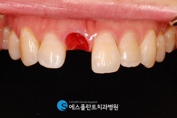 A case of regaining confidence with immediate implant placement after front tooth extraction at Esplant Dental Hospital, a dental clinic near Apgujeong Rodeo Station known for implants image 4